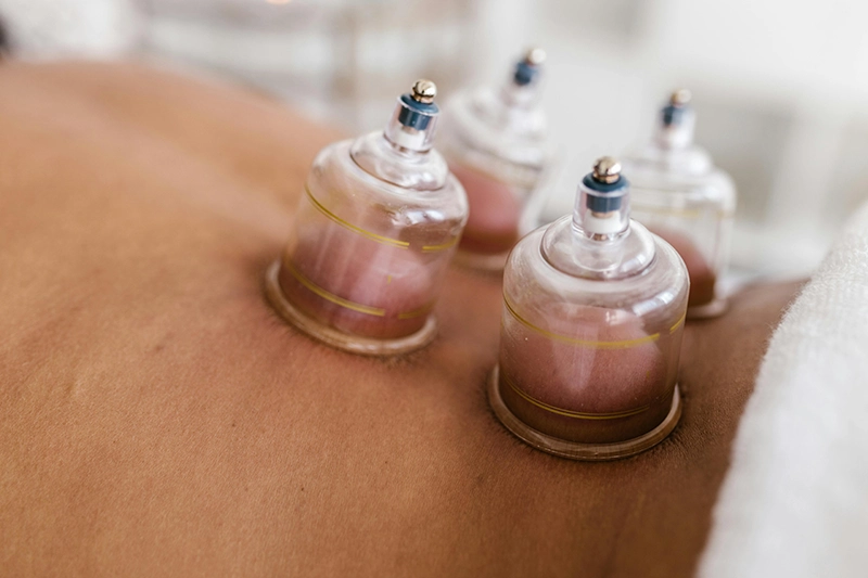 cupping therapy cheadle